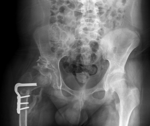 الأشعة السينية بعد الجراحية في عسر التصنُّع الوركي (DDH)