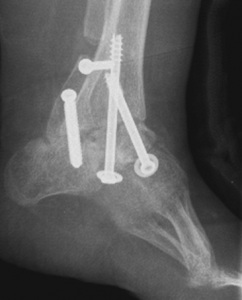 صورة الأشعة السينية بعد إجراء عمل جراحي لحَنَف القدم والسِّنسنة المشقوقة
