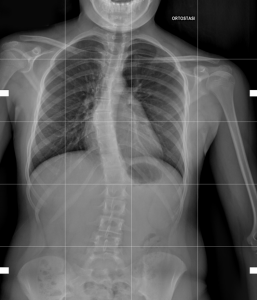 Scoliosis X-ray