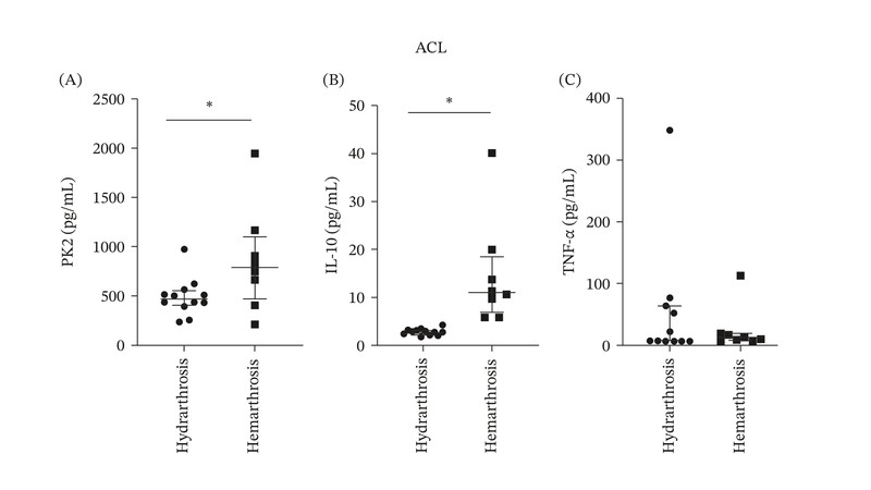 Grafici dei livelli di procineticina-2, IL-10 e TNF-α con emartro e con idrarto, in pazienti con lesione isolata del crociato anteriore